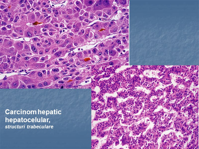Carcinom hepatic  hepatocelular,  structuri trabeculare